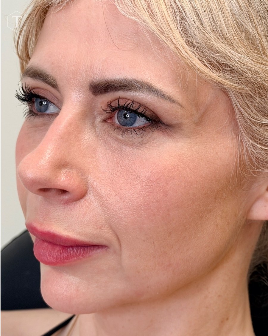 After treatment