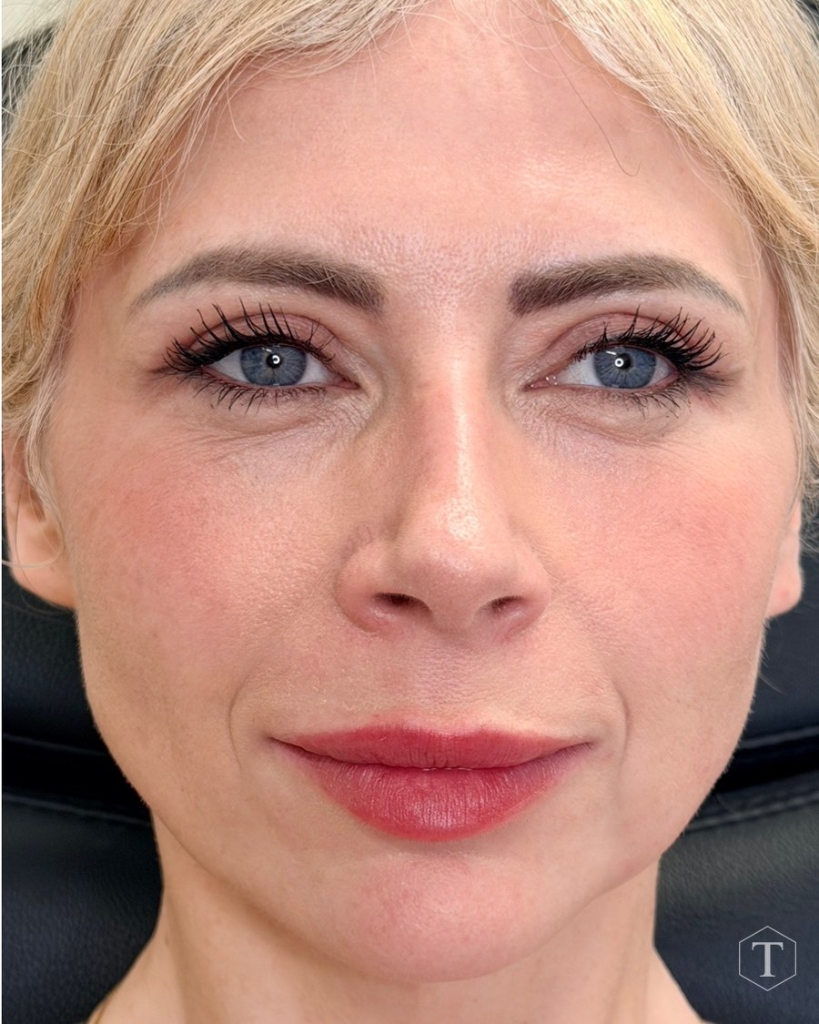 After treatment