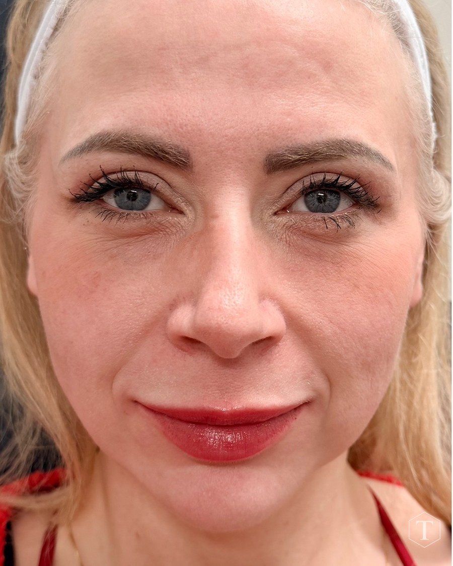 Before treatment