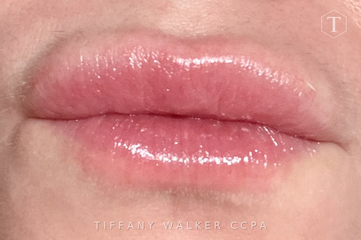 Lips before dissolving, showing migrated filler