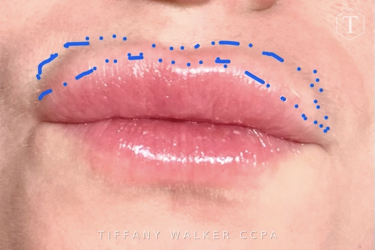 Assessment marking showing where filler had migrated