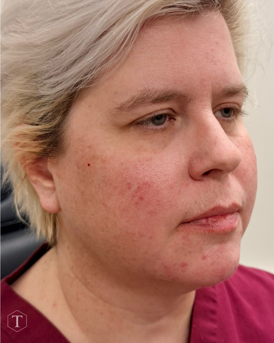 After dermal filler treatment