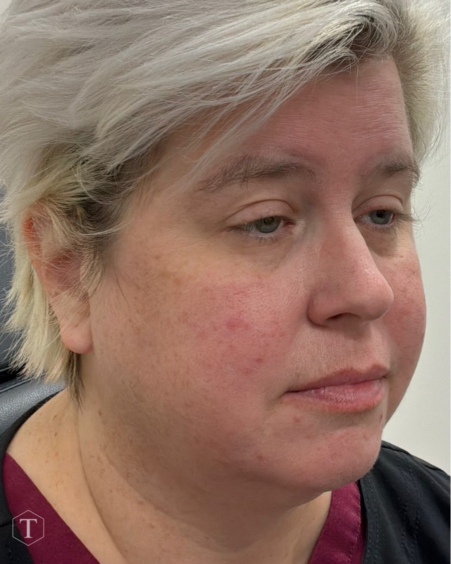 Before dermal filler treatment