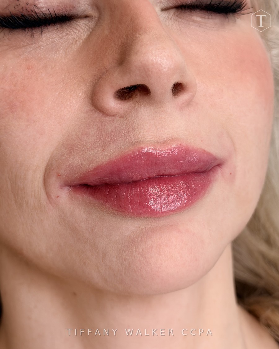 Lips after Swedish Lips treatment