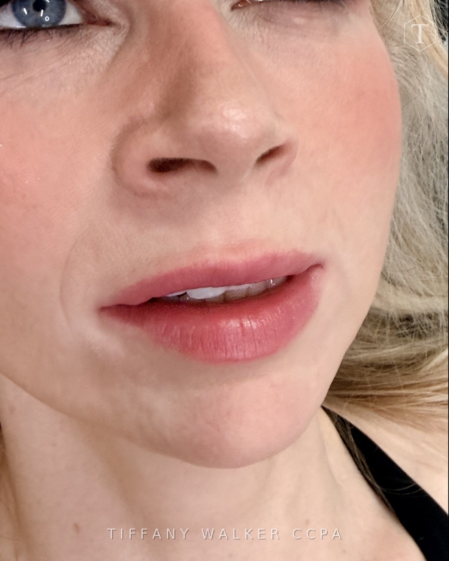 Lips before Swedish Lips treatment