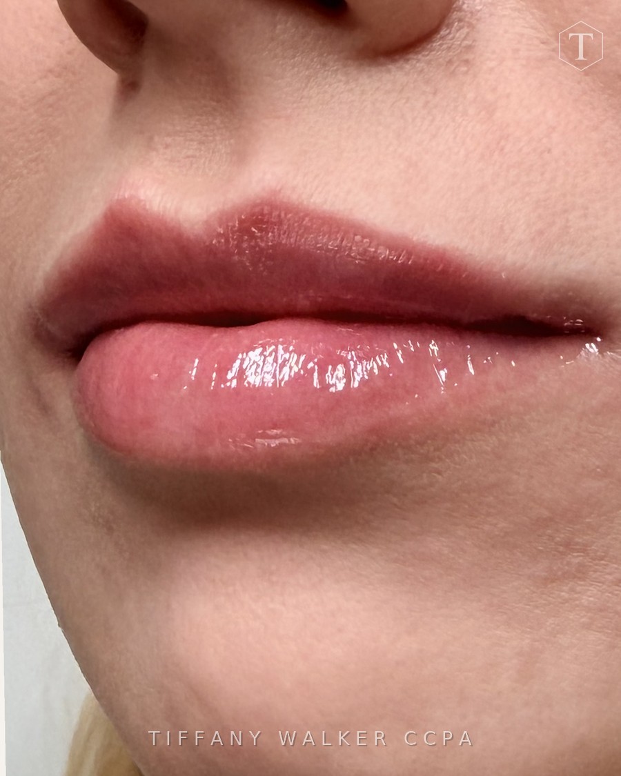 Lips after Swedish Lips treatment