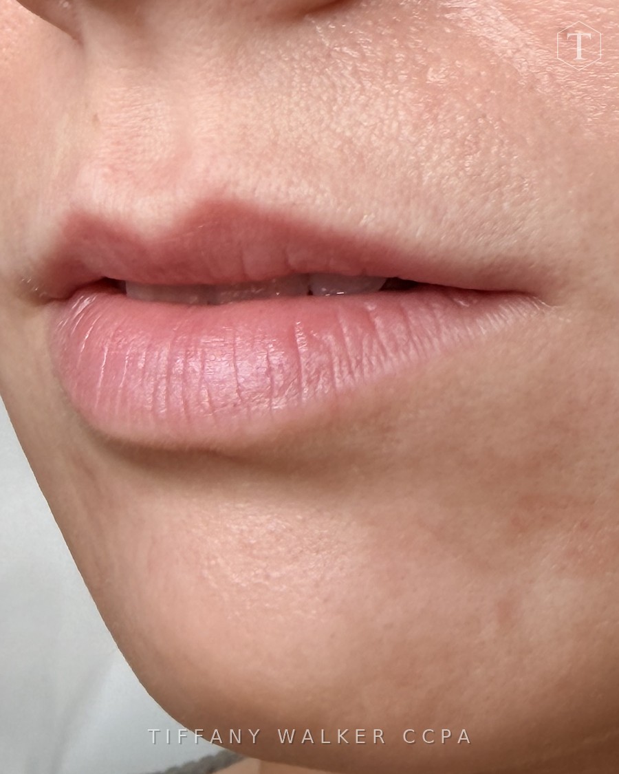 Lips before Swedish Lips treatment