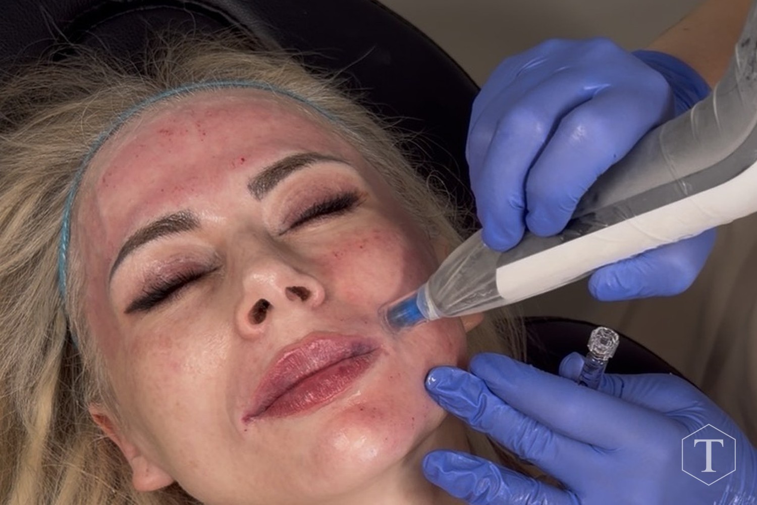 Medical-grade microneedling treatment in progress