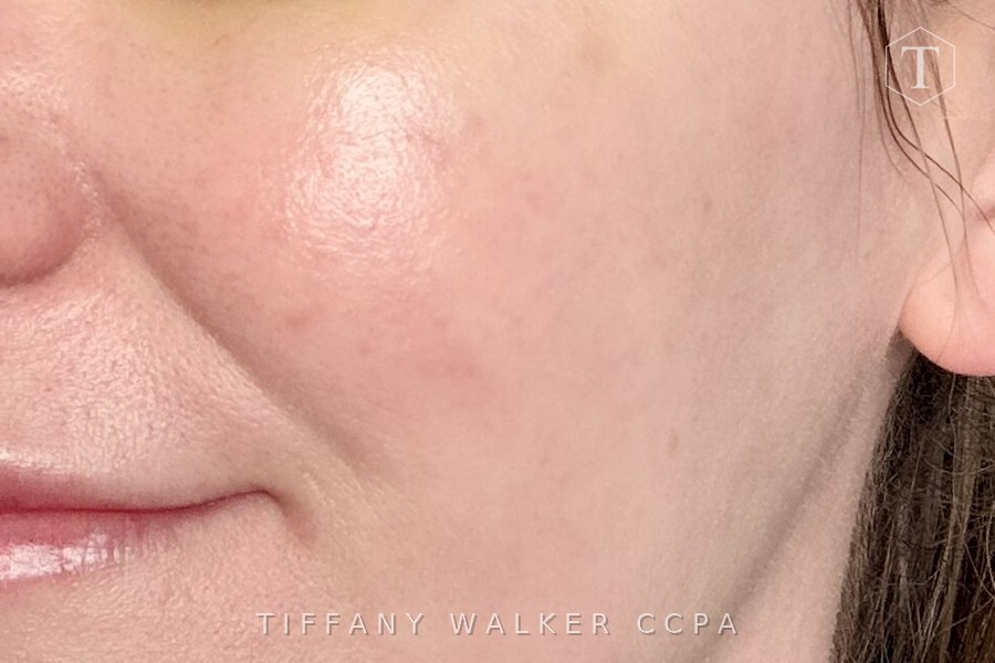 Cheek after MicroTox treatment for rosacea flushing