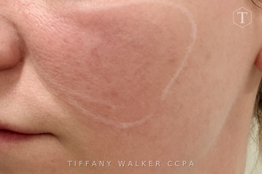 Cheek before MicroTox treatment for rosacea flushing