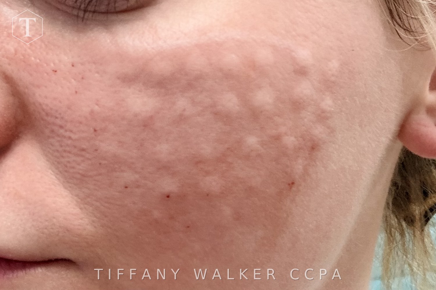Cheek immediately after MicroTox microdroplet injection
