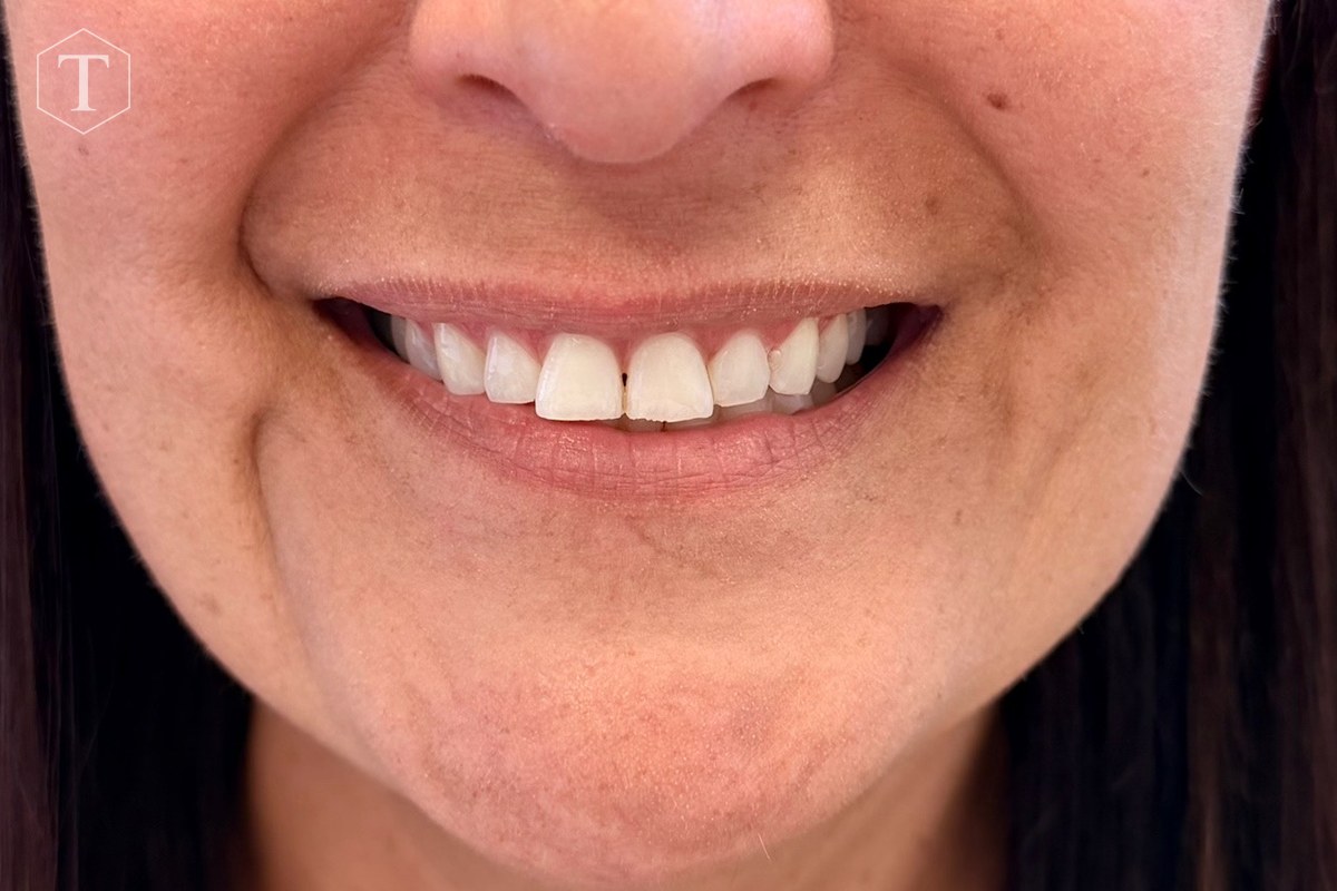 Smile after treatment for asymmetry