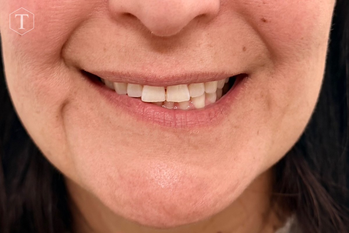 Smile before treatment for asymmetry