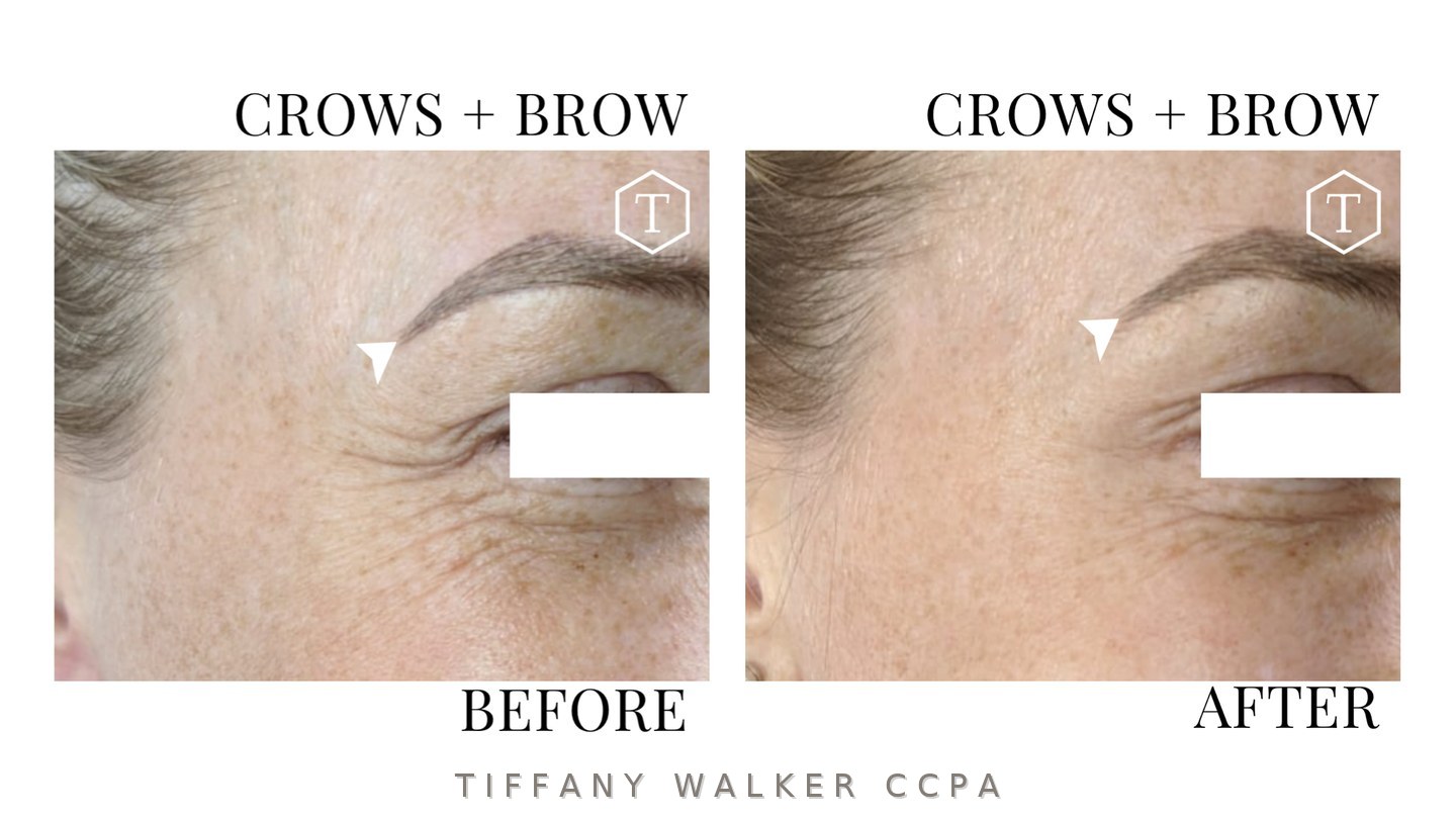 Crow&rsquo;s feet and brow before and after neuromodulator treatment