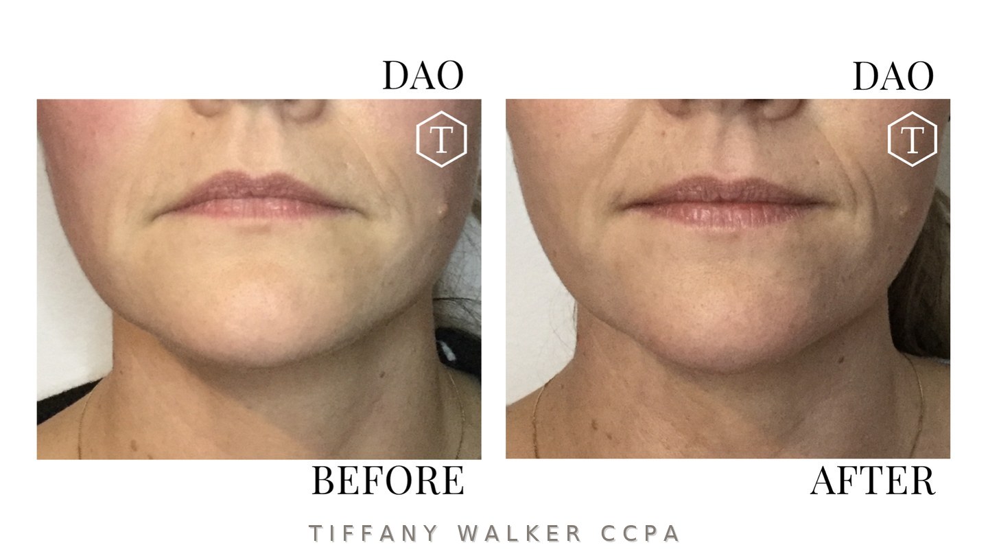 DAO before and after neuromodulator treatment