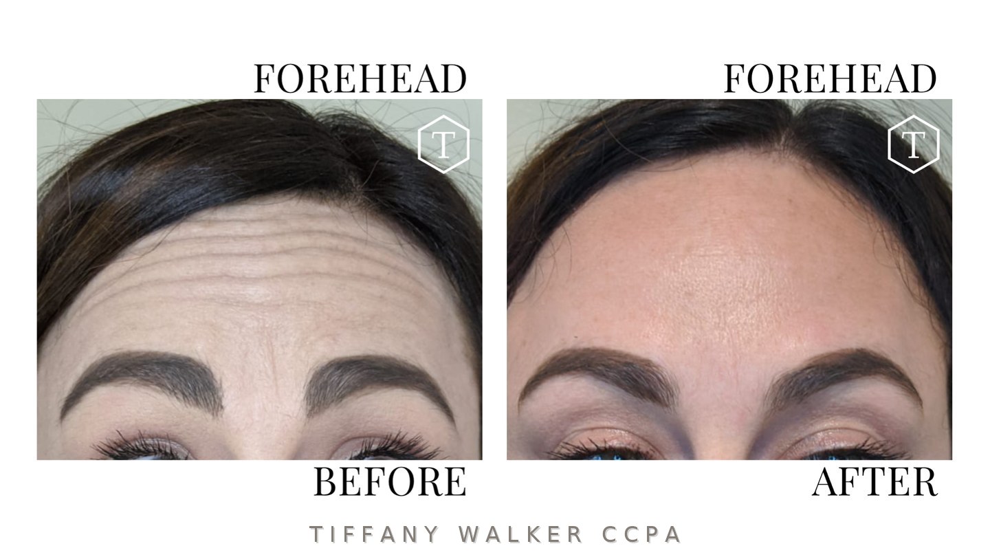 Forehead before and after neuromodulator treatment