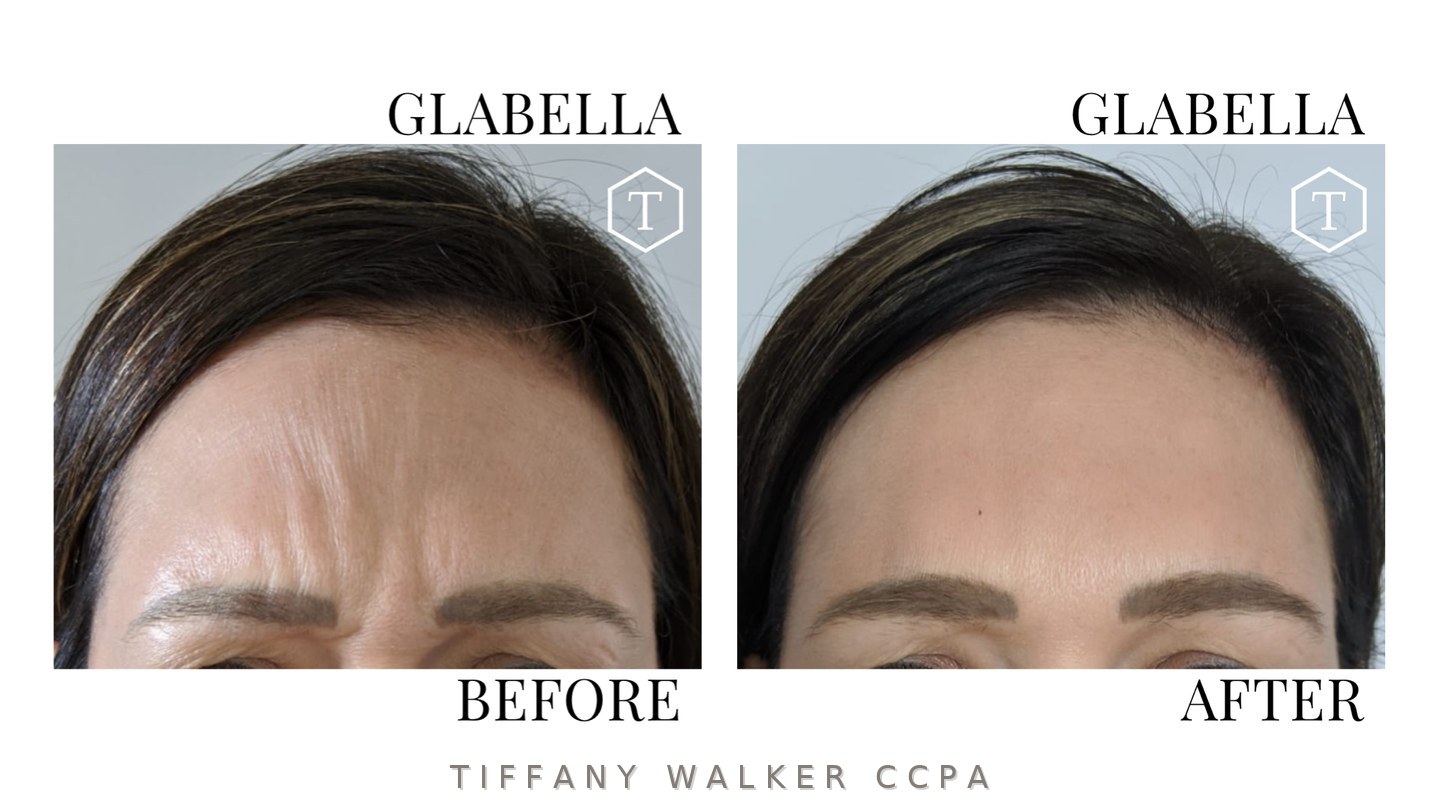 Glabella before and after neuromodulator treatment