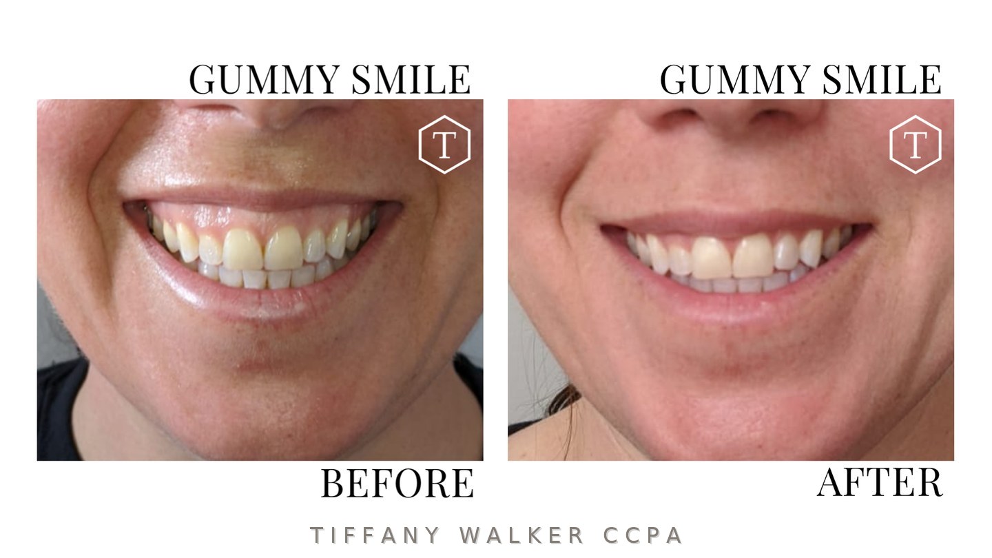 Gummy smile before and after neuromodulator treatment