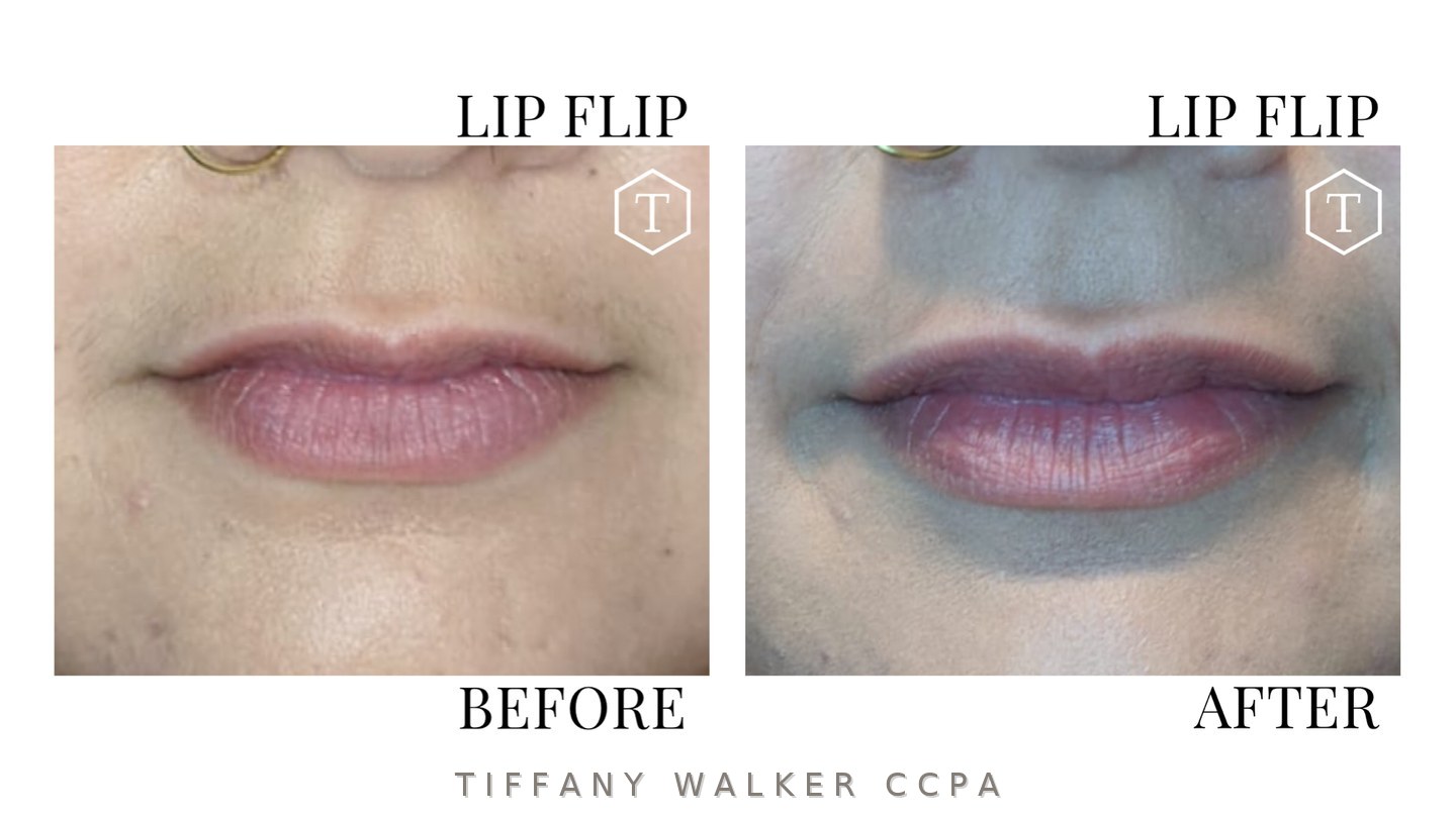 Lip flip before and after neuromodulator treatment